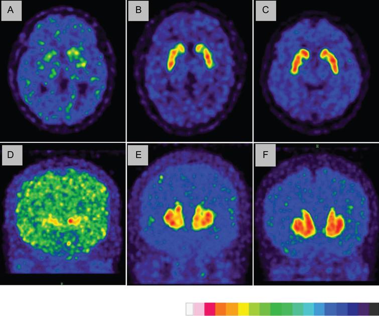 11C-CFT-PET in Presymptomatic FTDP-17: A Potential Biomarker Predicting ...