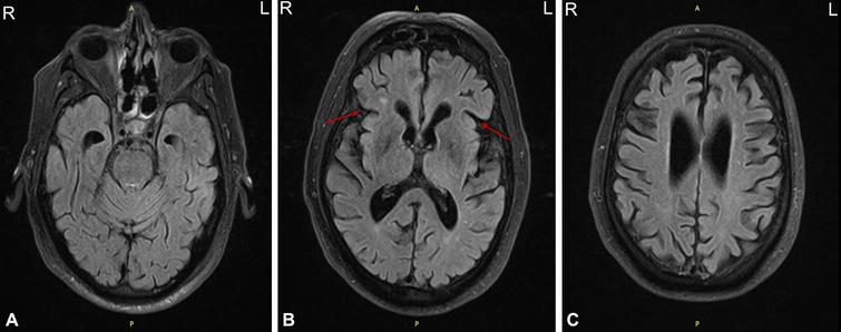 10mg Diazepam For Mri