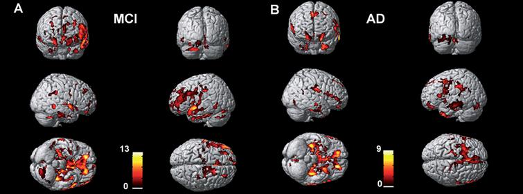 Tau Aggregation Correlates with Amyloid Deposition in Both Mild ...