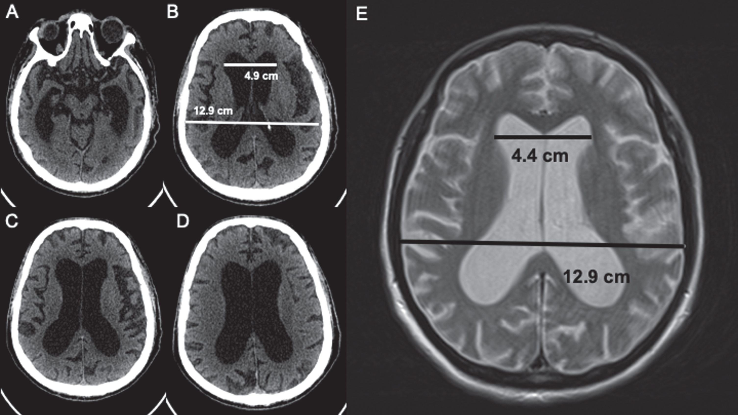 Normal Pressure Hydrocephalus In Down Syndrome The Report Of Two Cases Ios Press 7020