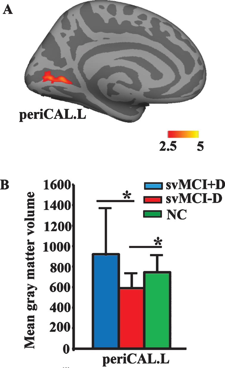 Cortical Alterations Are Associated With Depression In Subcortical Vascular Mild Cognitive Impairment Revealed By Surface Based Morphometry Ios Press