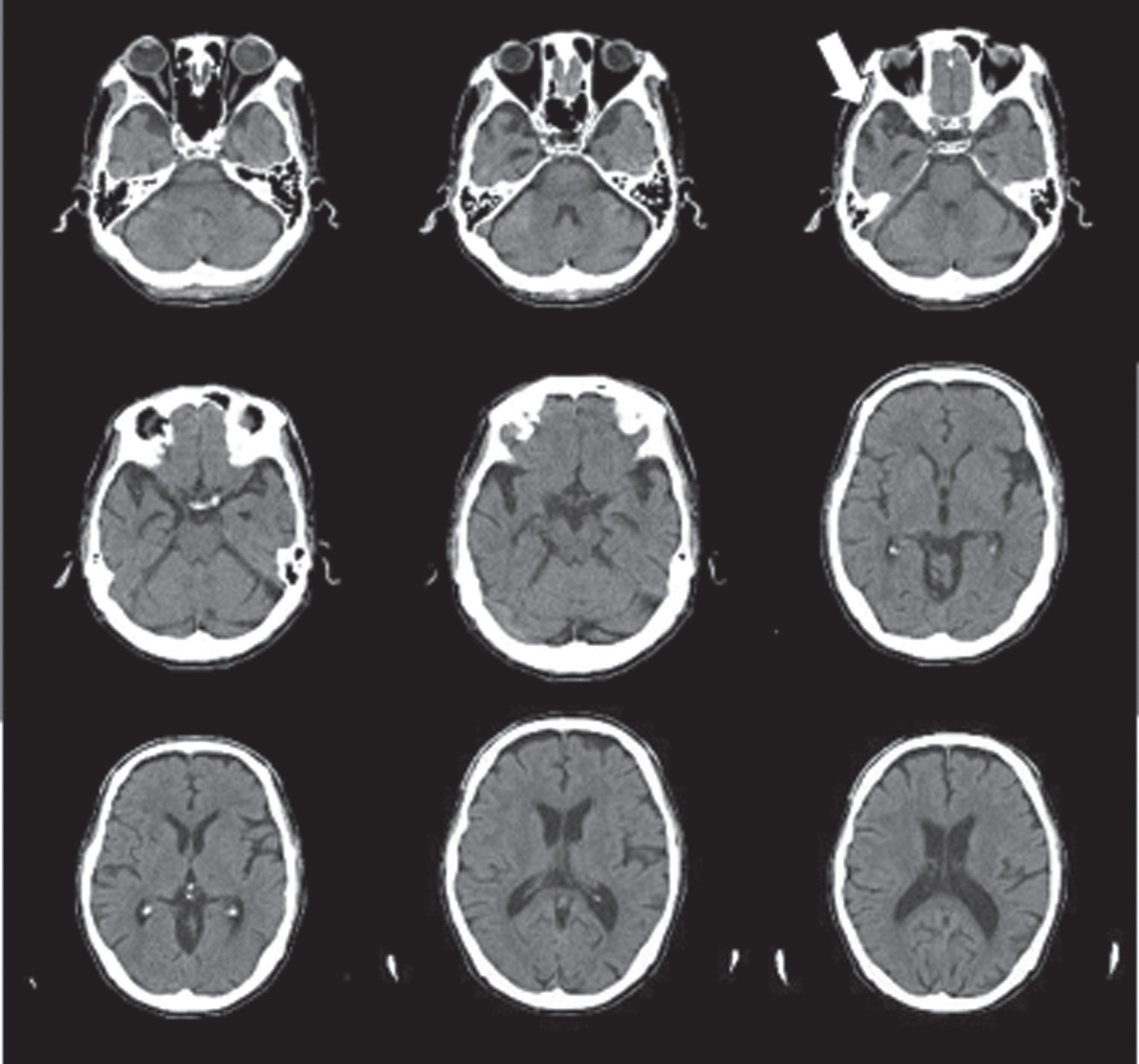 Semantic memory deficits are associated with pica in individuals