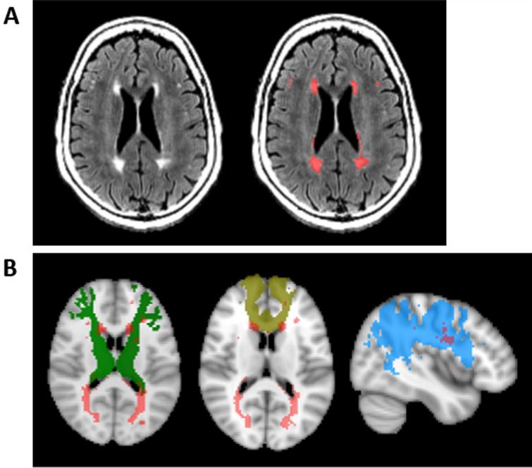 White Matter Hyperintensities and Apolipoprotein E Affect the ...