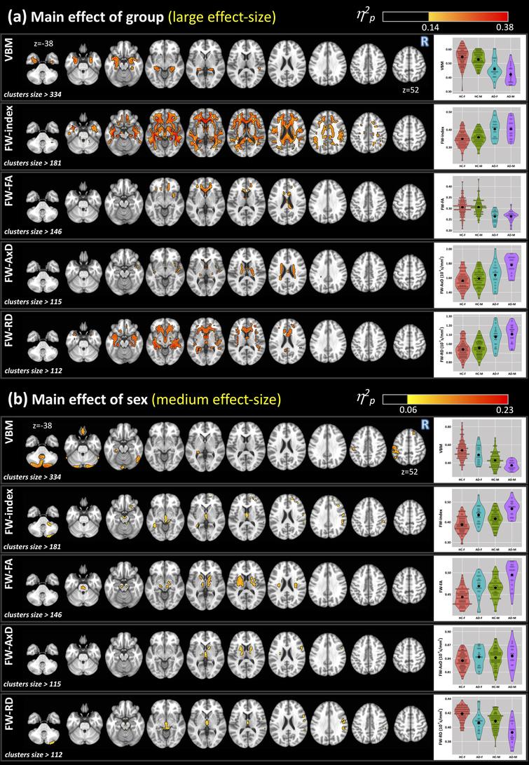 Sex Differences In Alzheimers Disease Revealed By Free Water Diffusion Tensor Imaging And Voxel 9126