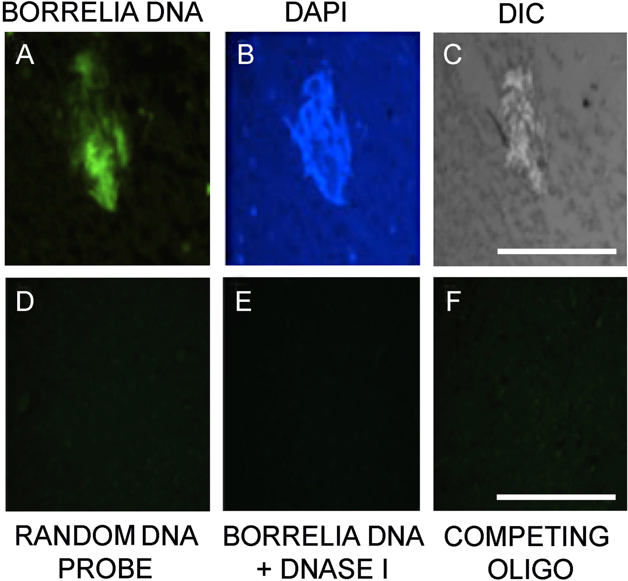 Borrelia Burgdorferi Co-Localizing With Amyloid Markers In Alzheimer’s ...