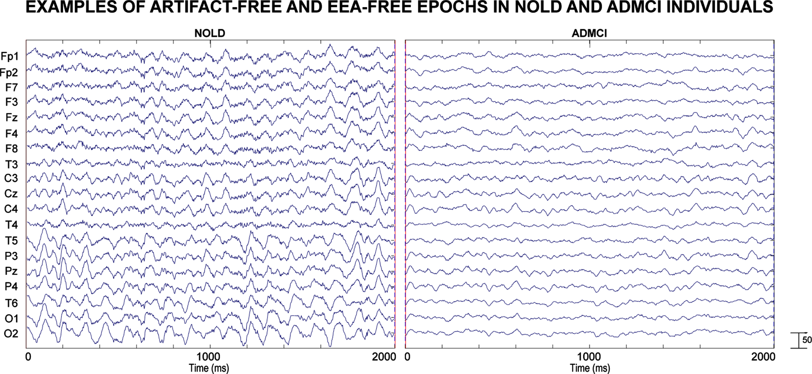 Alzheimer’s Disease with Epileptiform EEG Activity: Abnormal Cortical ...