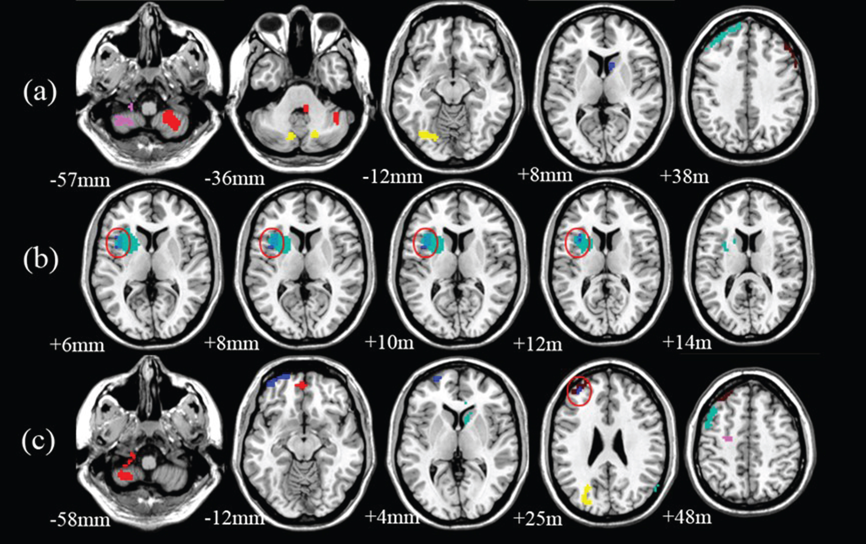 Shared and Specific Changes of Cortico-Striatal Functional Connectivity in  Stable Mild Cognitive Impairment and Progressive Mild Cognitive Impairment  - IOS Press