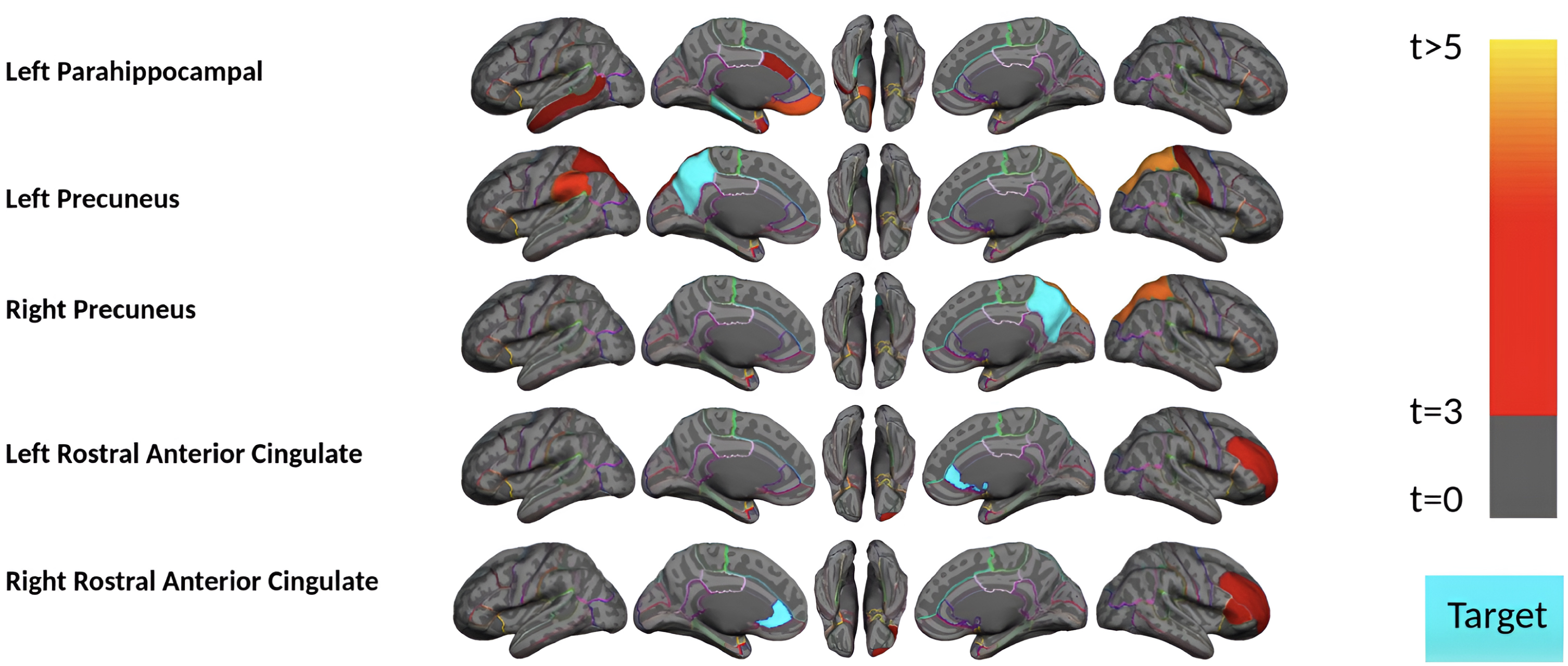 Remote Associations Between Tau and Cortical Amyloid-β Are Stage-Dependent  - IOS Press