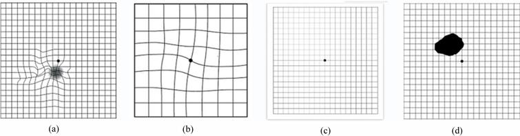 Development And Validation Of Functional Based Grading For Macular Diseases Ios Press