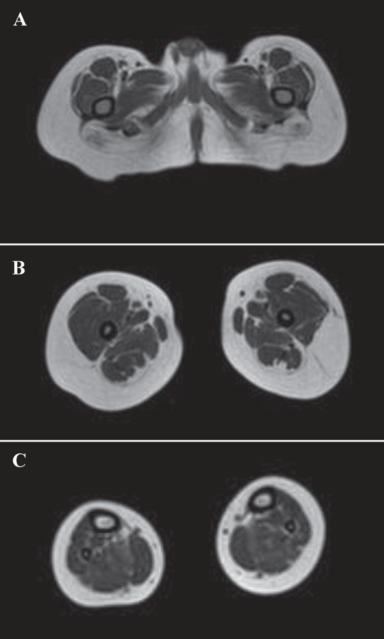 Carey Fineman Ziter Syndrome A Mymk Related Myopathy Mimicking Brainstem Dysgenesis Ios Press