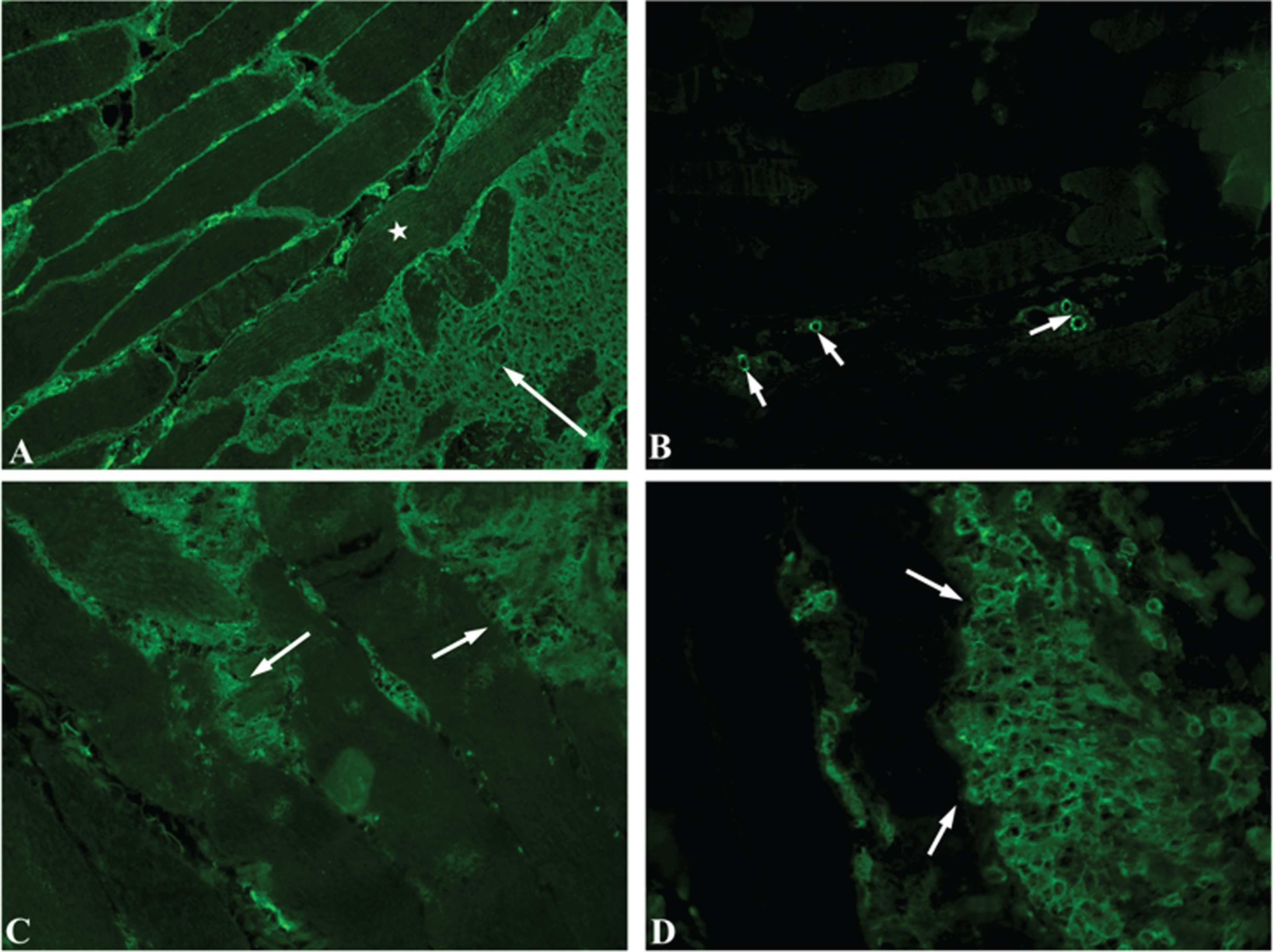 Severe inflammatory myopathy in a pulmonary carcinoma patient treated ...