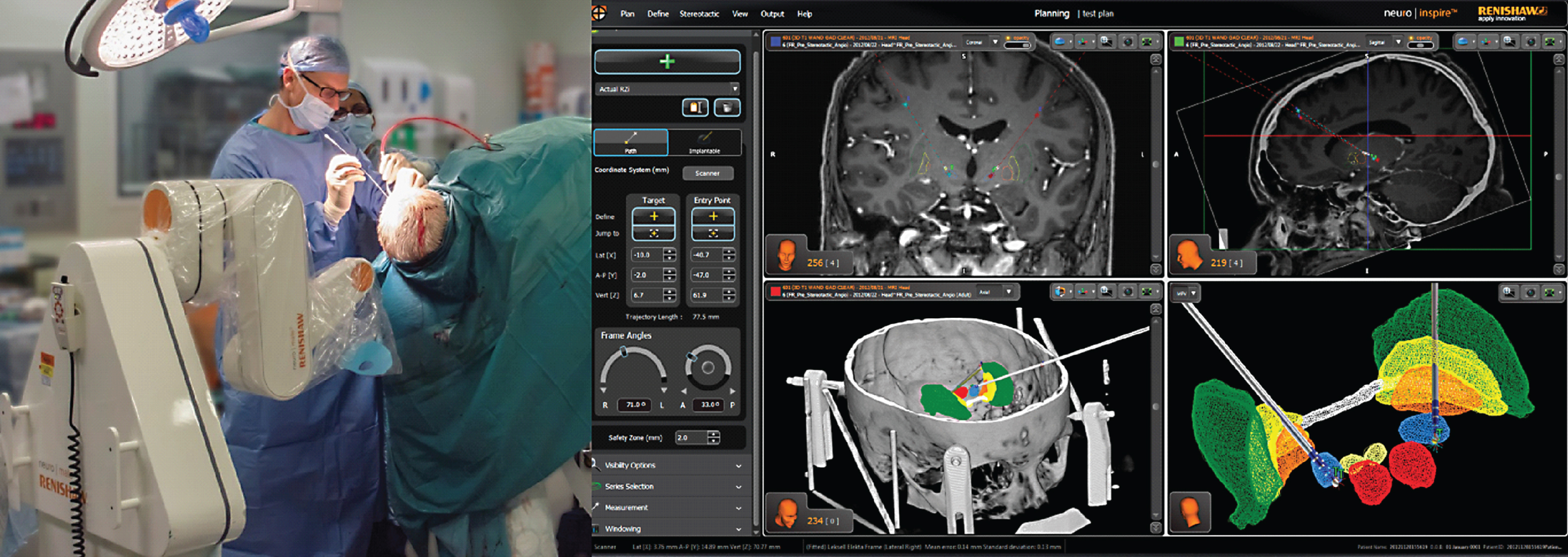 Technological Advances In Deep Brain Stimulation - IOS Press