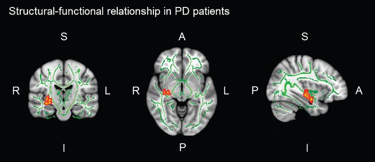 Verbal Memory in Parkinson's Disease: A Combined DTI and 