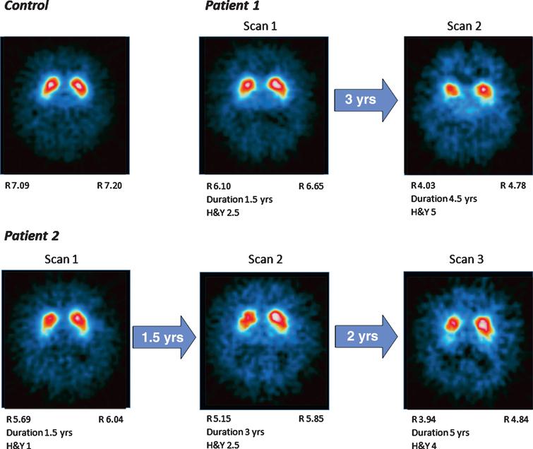 Progressive Dopamine Transporter Binding Loss In Autopsy Confirmed