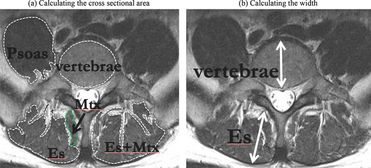 The Cross-Sectional Area of Paraspinal Muscles Predicts the Efficacy of