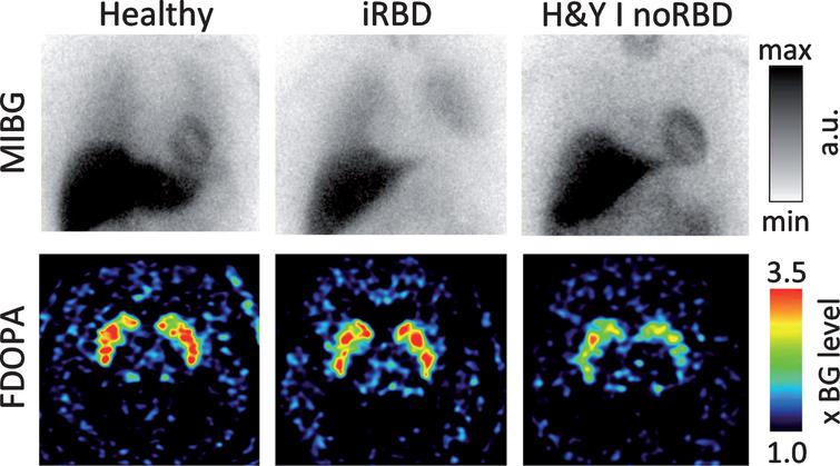 Brain-First versus Gut-First Parkinson’s Disease: A Hypothesis - IOS Press