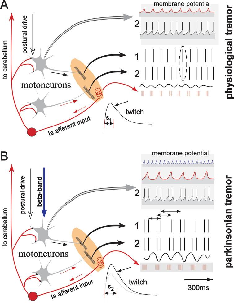 Tremor In Parkinson S Disease May Arise From Interactions Of Central Rhythms With Spinal Reflex Loop Oscillations Ios Press