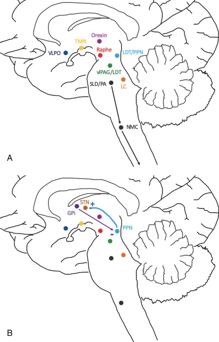 The Impact of Deep Brain Stimulation on Sleep in Parkinson’s Disease ...