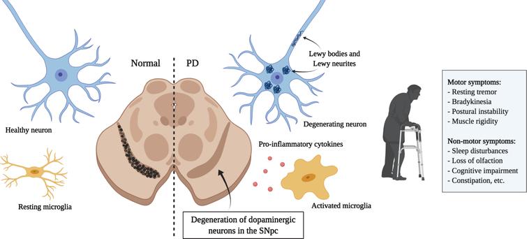 treating-parkinson-s-disease-with-antibodies-previous-studies-and