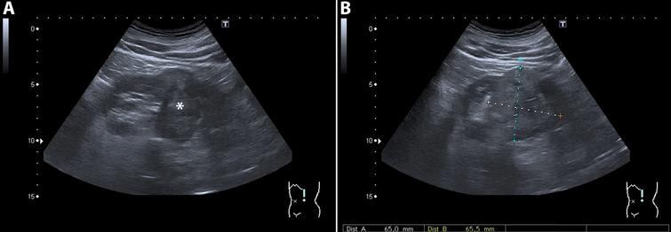 Renal Cancer Ultrasound