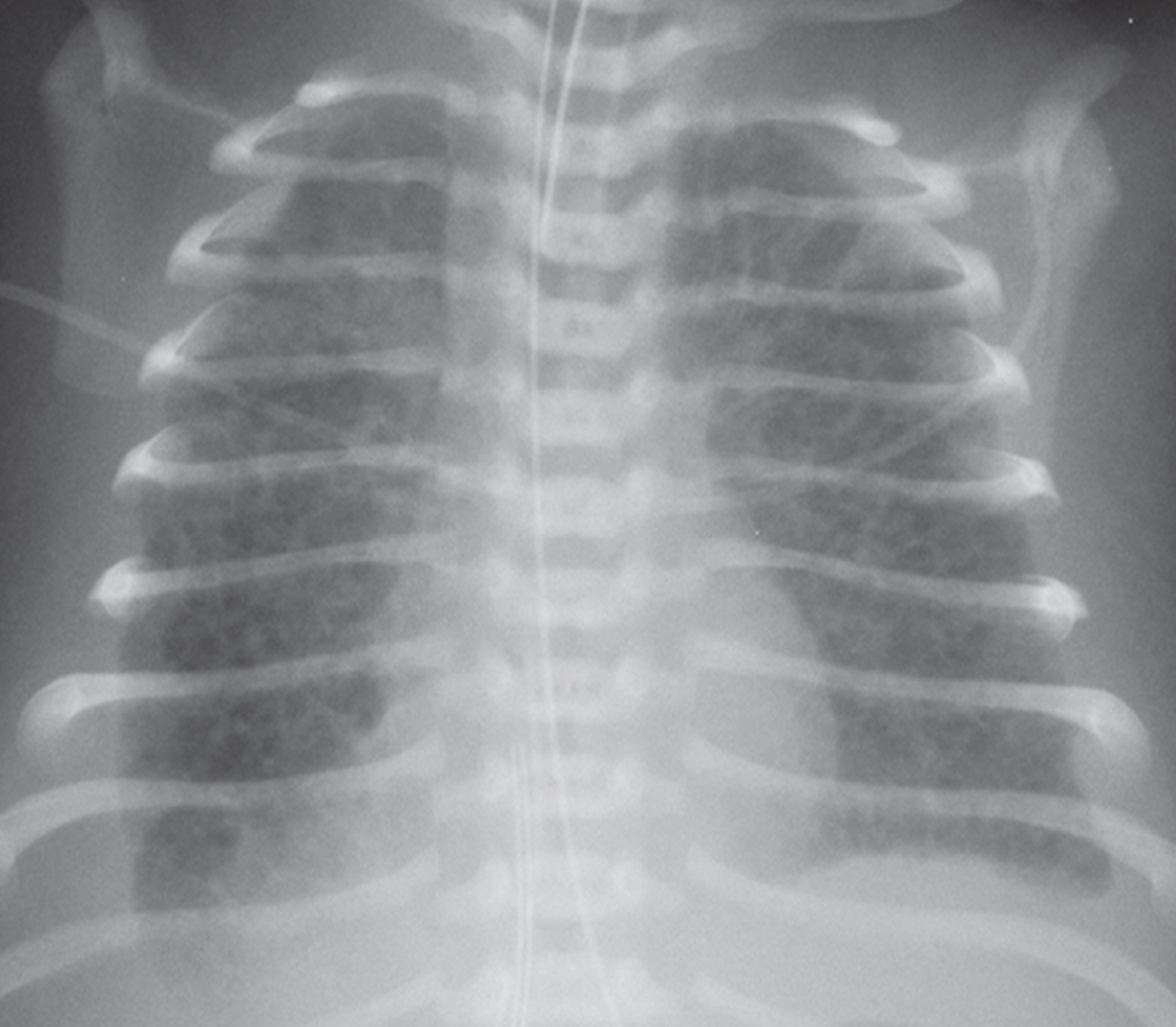 Pulmonary interstitial glycogenosis in a patient with trisomy 21 - IOS ...