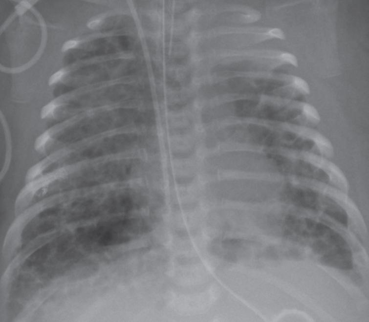 Pulmonary interstitial glycogenosis in a patient with trisomy 21 - IOS ...