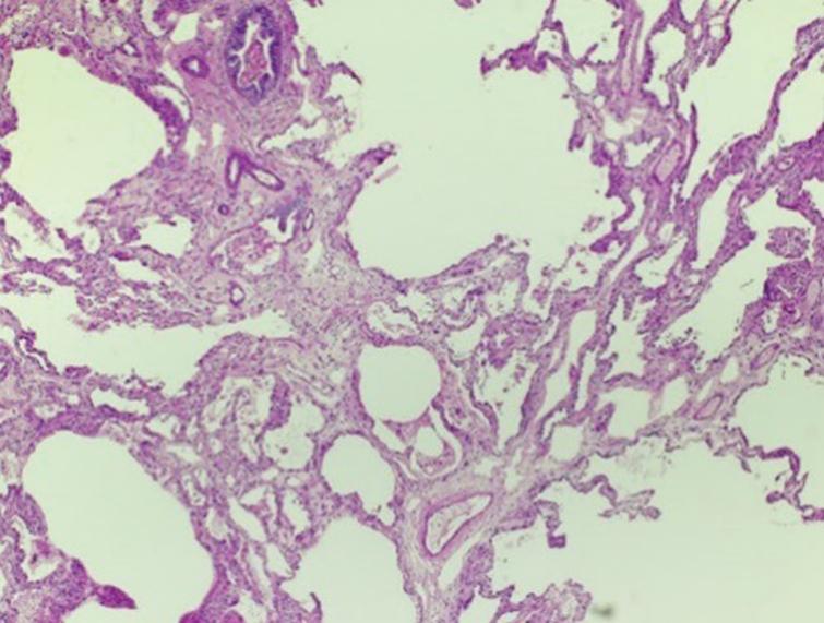 Pulmonary interstitial glycogenosis in a patient with trisomy 21 - IOS ...