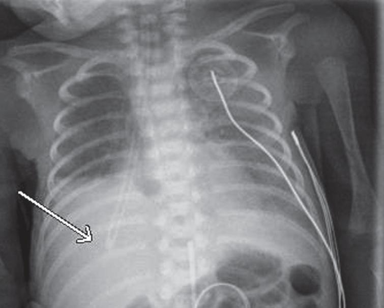 Retained surfactant catheter and pneumothorax in a premature neonate ...