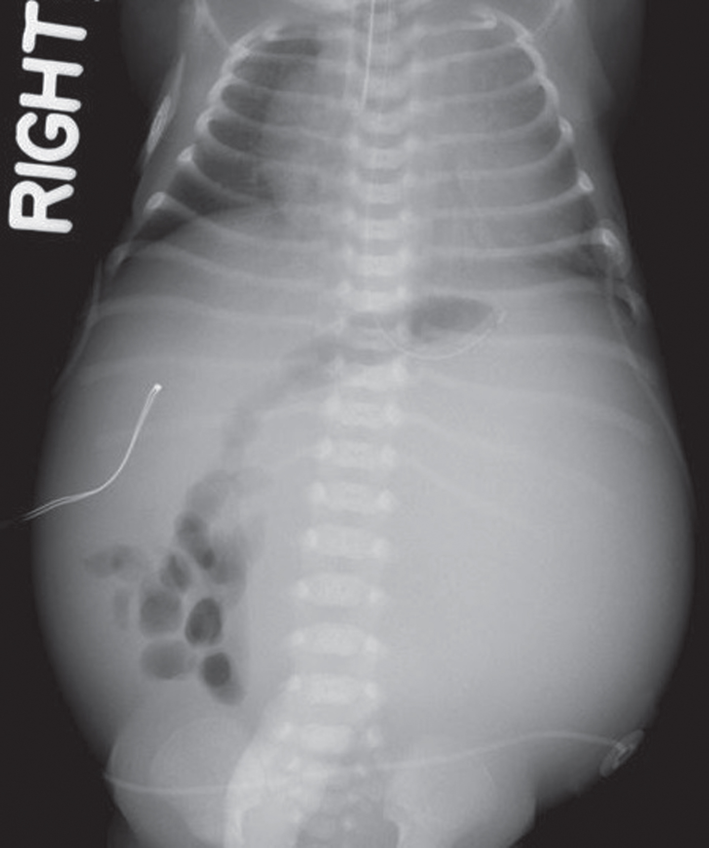 Management of mixed type congenital mesoblastic nephroma: Case series ...