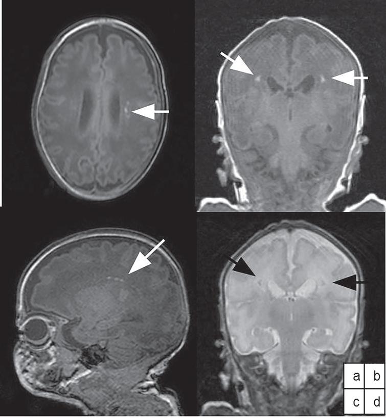 Isolated neonatal MRI punctate white matter lesions in very preterm ...