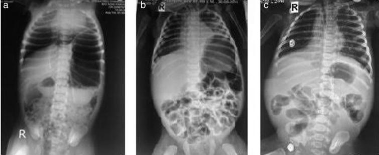 Erb’s palsy complicating a case of annular pancreas - IOS Press