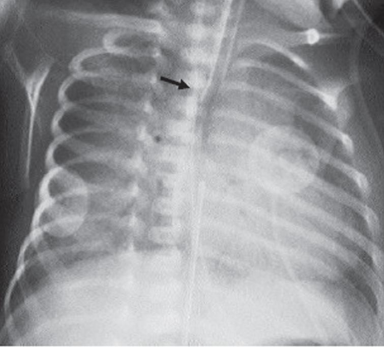 Extravasation of total parenteral nutrition into the liver from an ...