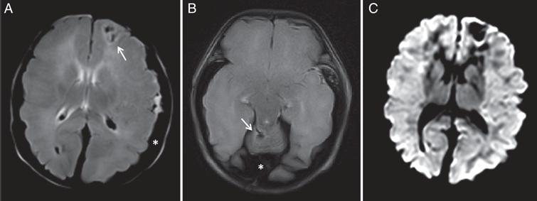 T2* cerebral magnetic resonance imaging showing left 