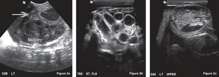 Worsening anemia associated with volvulus in a stable neonate with