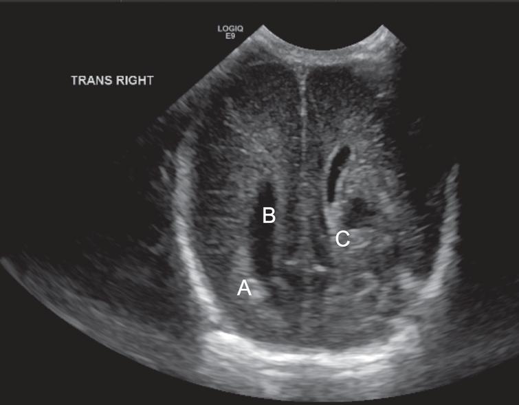 Central diabetes insipidus: A rare complication of IVH in a very low ...