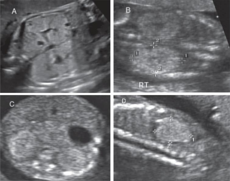 Renal Cystic Diseases During The Perinatal And Neonatal Period - Ios Press