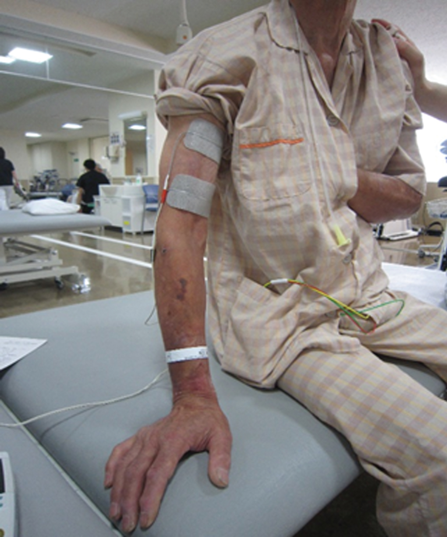 Pivot Physical Therapy - Electrical stimulation (e-stim) is a