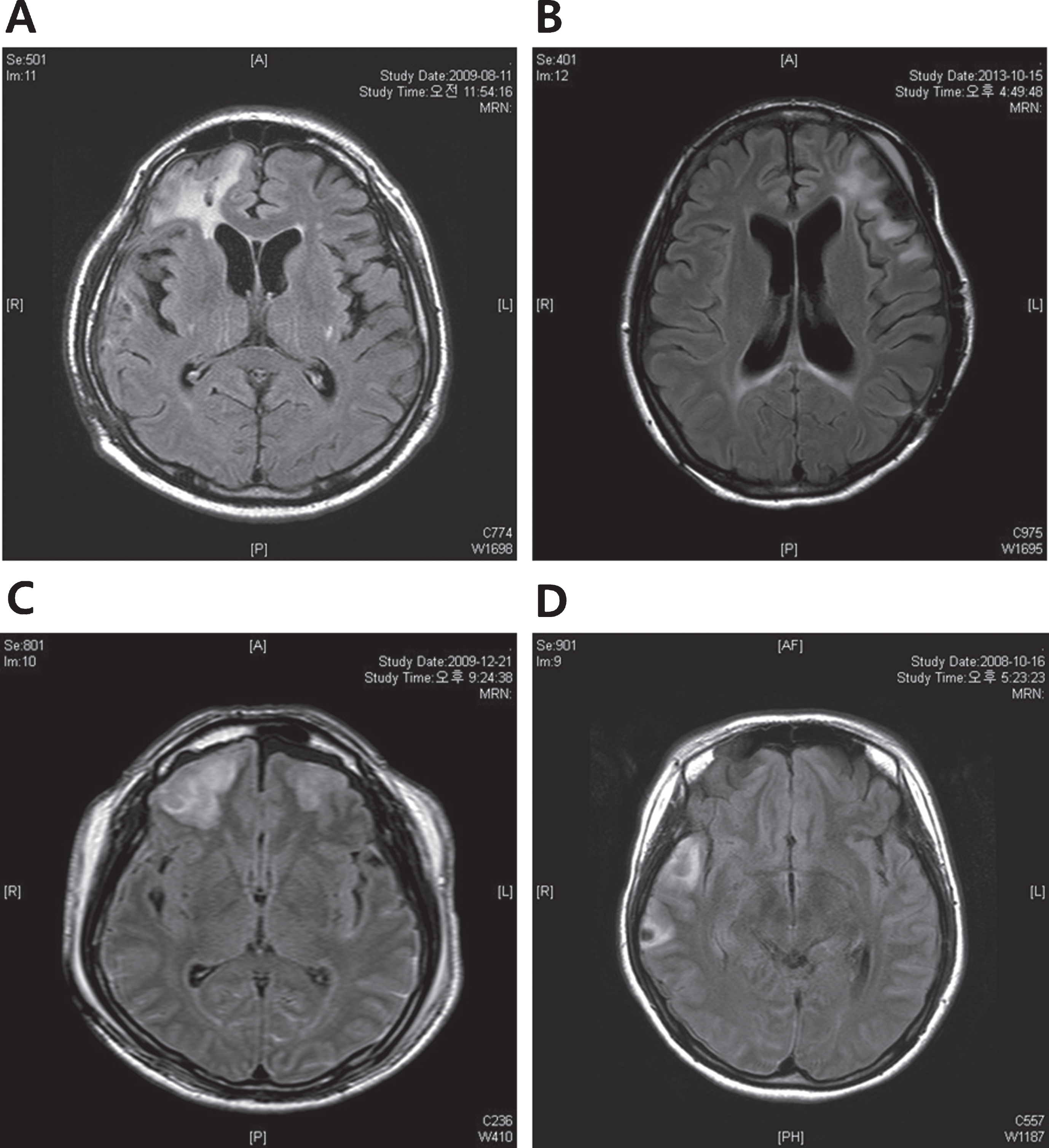 Factors Affecting Cognition And Emotion In Patients With Traumatic ...