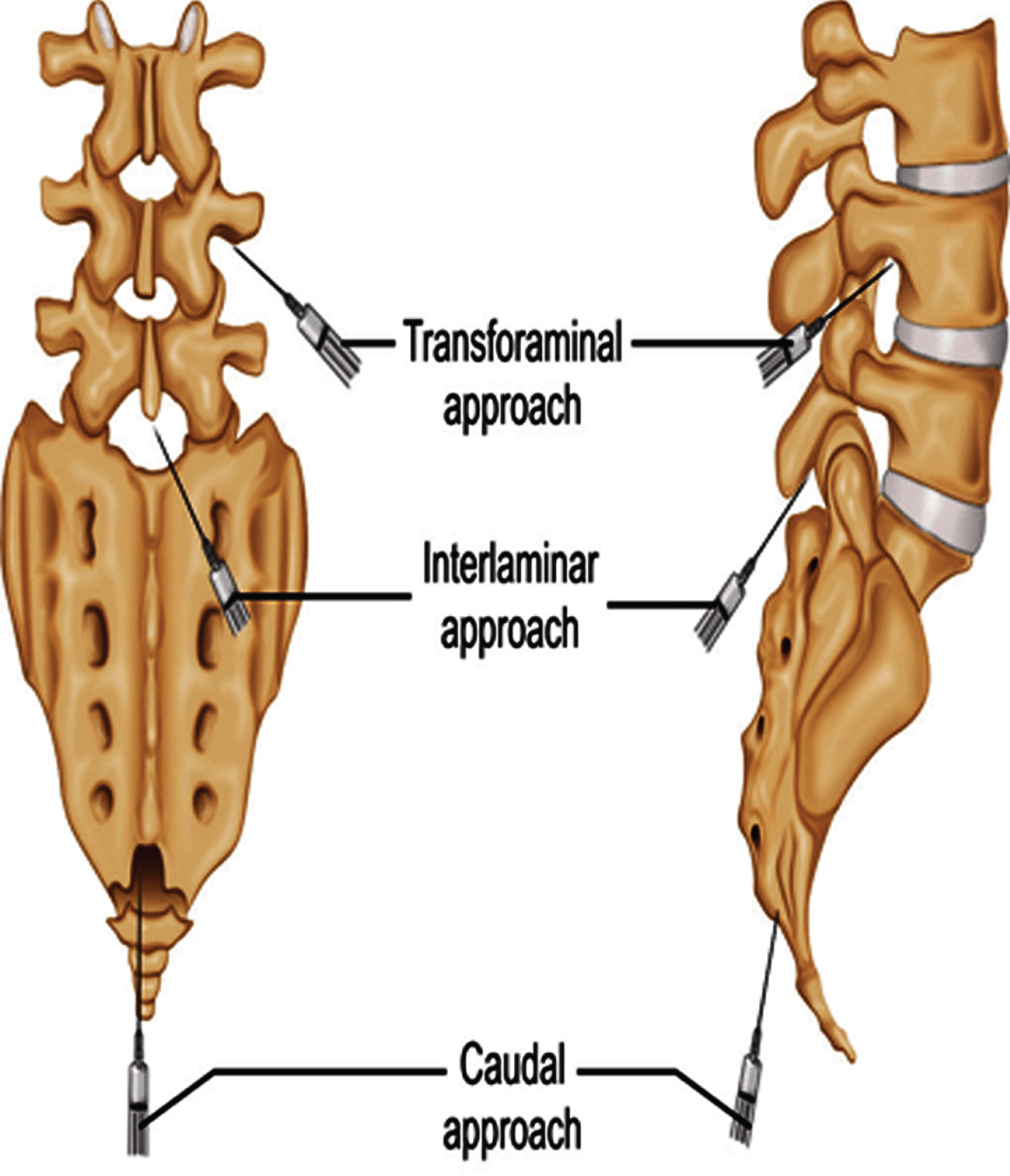 A minimally invasive surgical approach for the treatment of piriformis  syndrome: a case series, Chinese Neurosurgical Journal