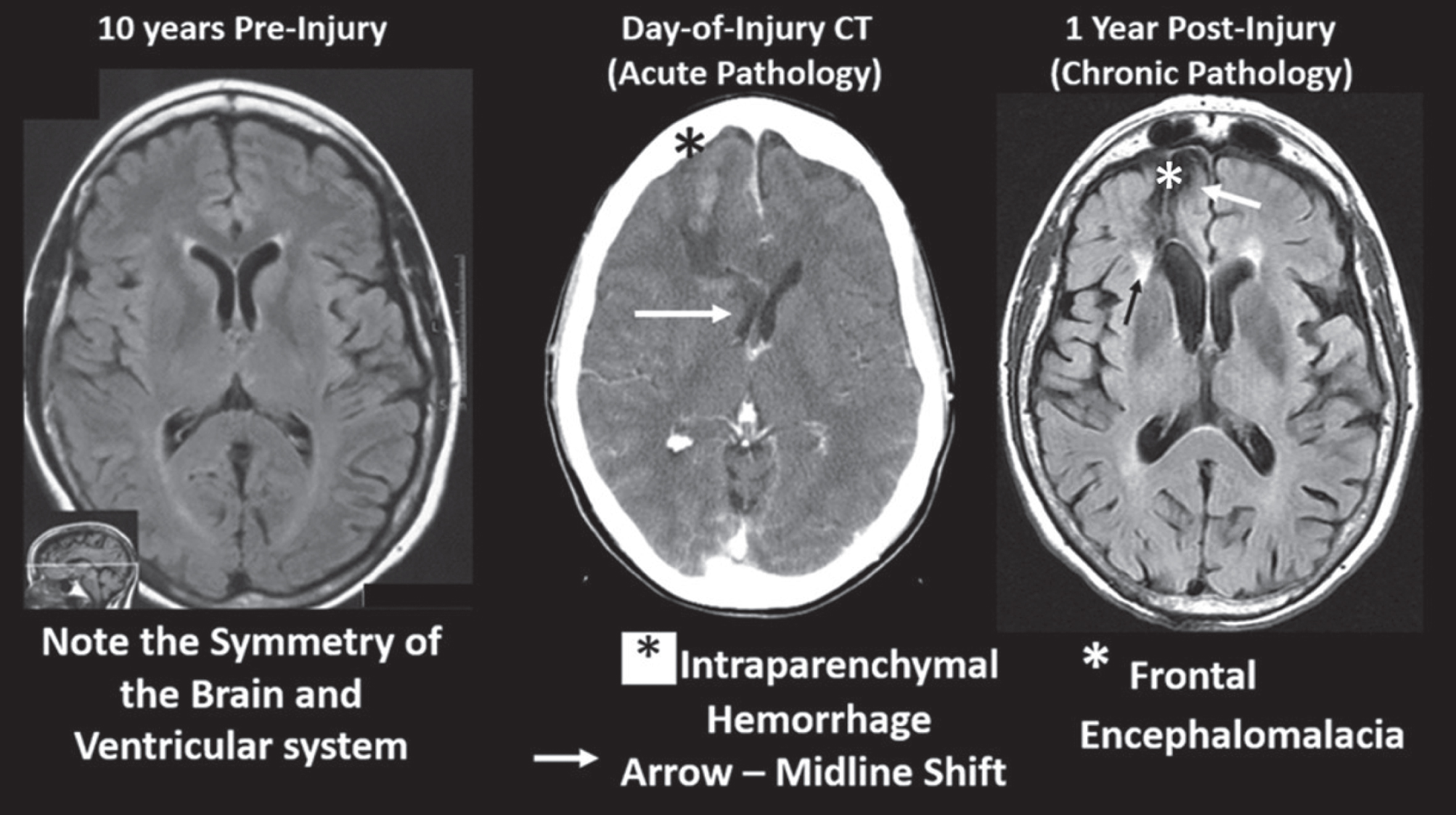 PDF) Microhemorrhage Pathology in Traumatic Brain Injury (TBI): Clinical  and Radiologic Features