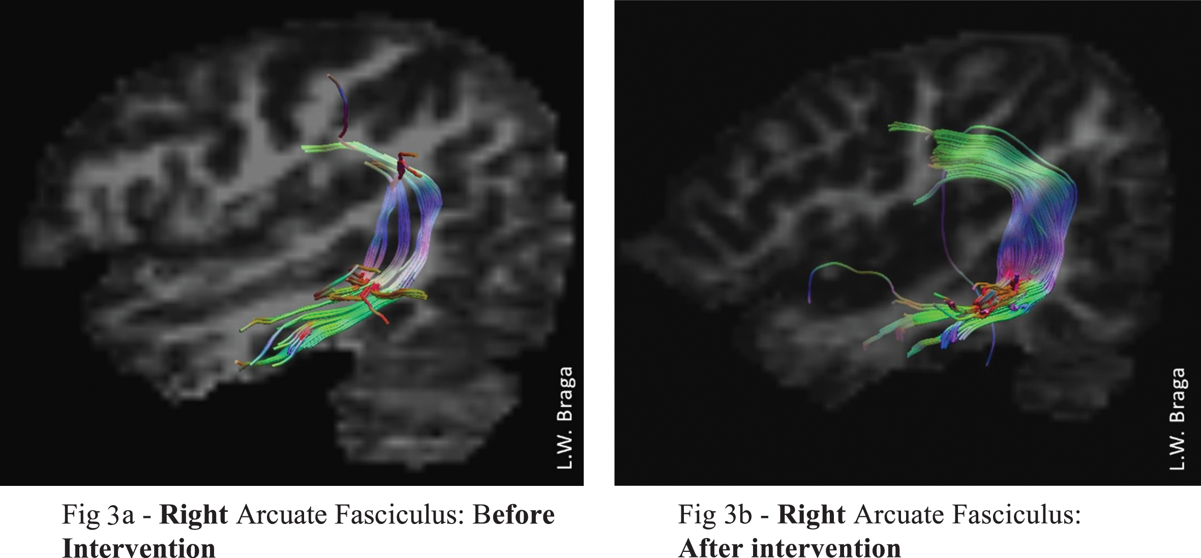 Neuropsychological Rehabilitation, Neuroimaging And Neuroplasticity: A ...