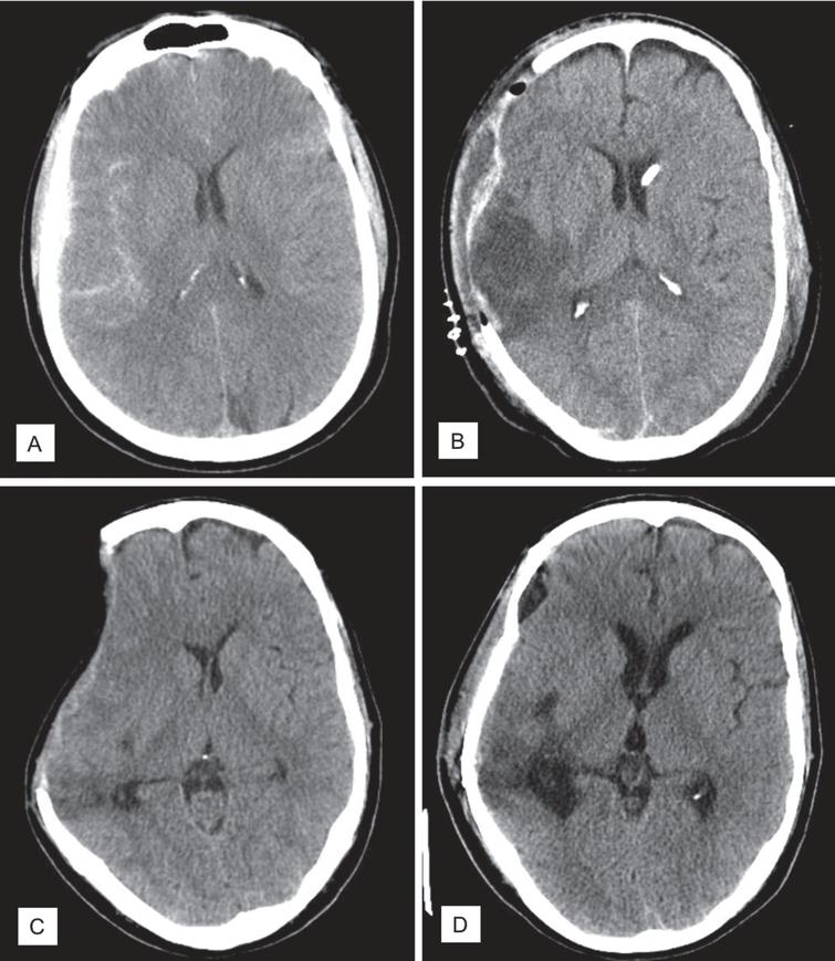 Postural neurologic deficits after decompressive craniectomy: A case ...