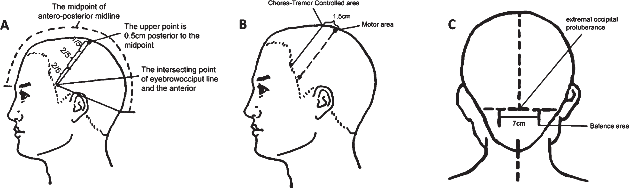 Feasibility and positive effects of scalp acupuncture for modulating ...