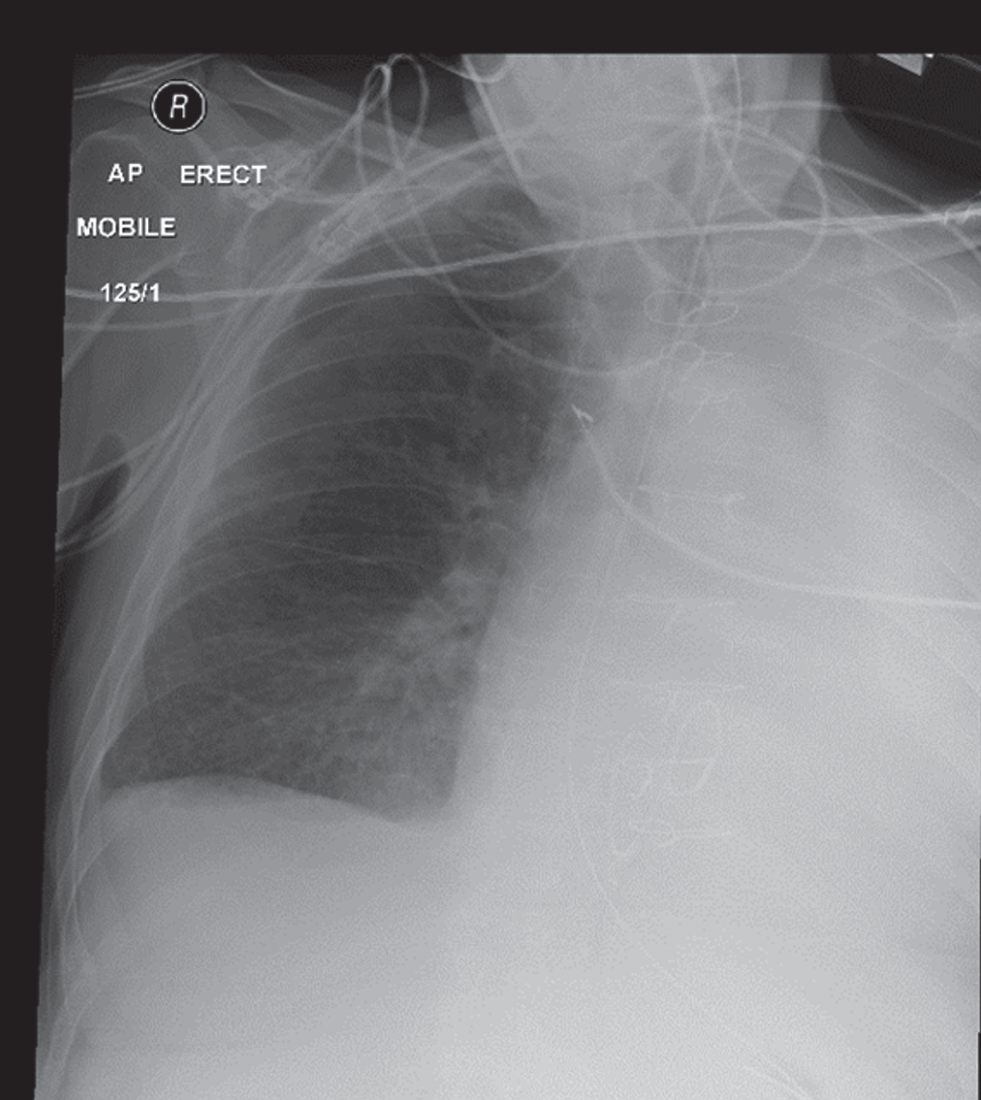 Hemithorax white-out (differential)