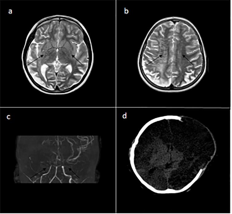 Status dystonicus: Diagnosis and management of a rare and challenging ...