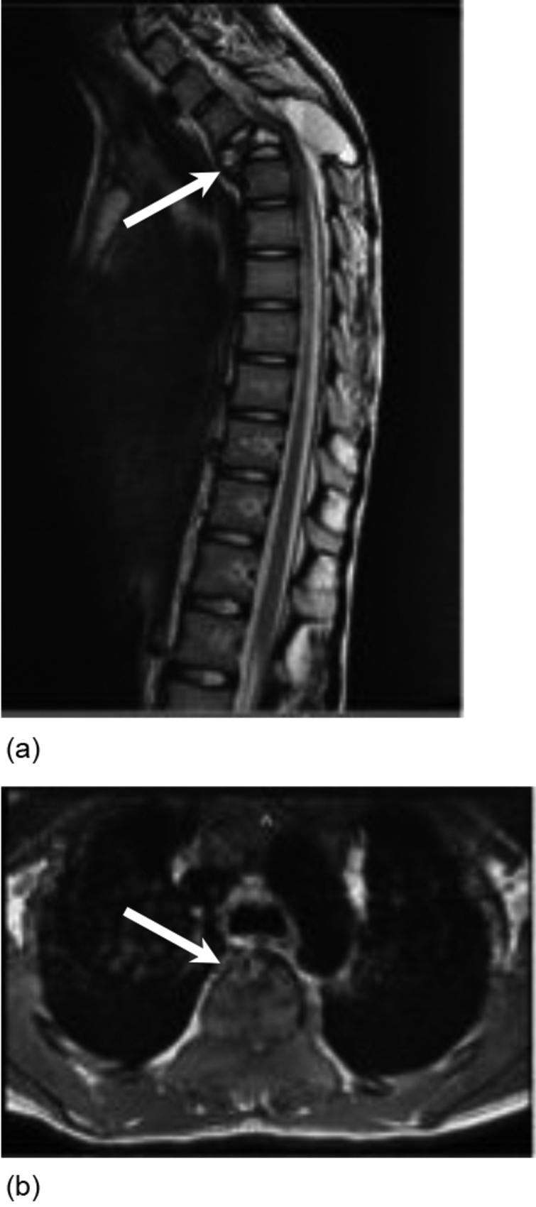 Rehabilitation of a child with a complicated aneurysmal bone cyst - IOS ...