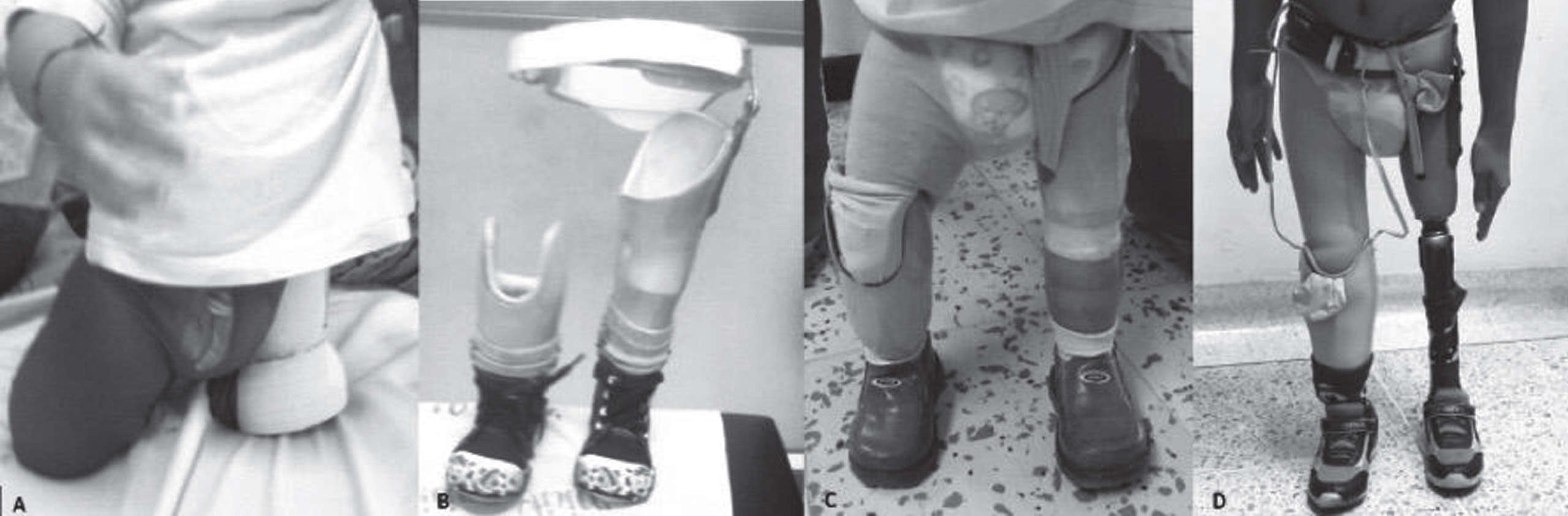 Prosthetic Rehabilitation In A Bilateral Lower Limb Pediatric Amputee ...