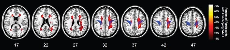 Relation of white matter hyperintensities and motor  