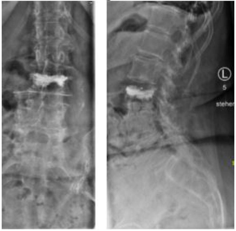 The Vertect Jack Device: A new method for augmentation of vertebral ...