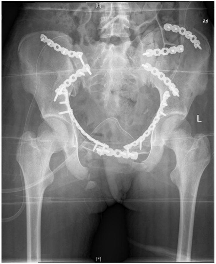 Anterior fracture dislocation of the sacroiliac joint A case report